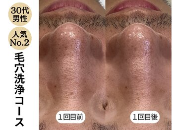 ディレイア ザ コスメ 有楽町マルイ店(direia the cosme)/メンズ/角栓/黒ずみ［有楽町］