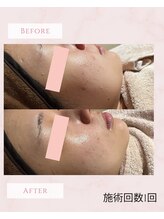 リチェルカ(Ricerca)/ハーブピーリングでニキビケア★