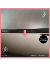 ブロンズ(BRONZE)/ひざ上