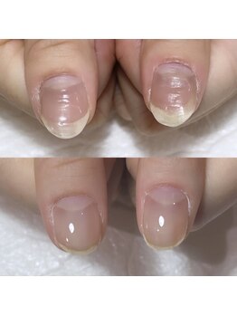 セラキュアネイル(Theracure nail)/爪の凹凸も綺麗に整うネイル
