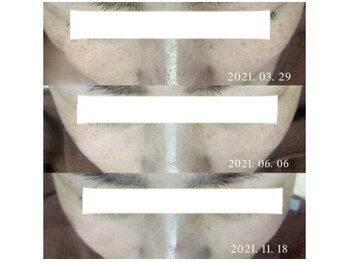 ブランシェ 高岡店 × 椿/シミケア『40代のお客様』