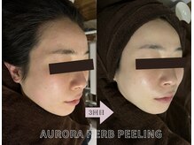 アイル(iru)/くすみがとれてぱっと明るく！