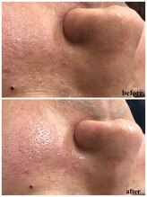 ヒルナム(Heal Nam)/毛穴エクストラクション