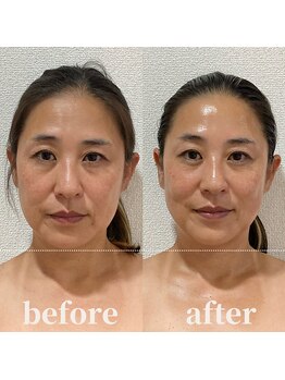 ロータス ビューティー(LOTUS Beauty)/小顔/リフトアップ