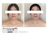 ☆お悩み別☆光フェイシャル　4回目以降のご予約の方はこちら！