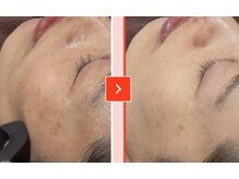 ベラピエル(BELLA Piel)/基山初のララピール　3回