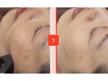 ベラピエル(BELLA Piel)/基山初のララピール 3回