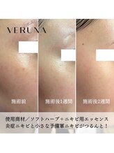 ココ 2号店(CoCo)/ハーブピーリング/ソフトハーブ