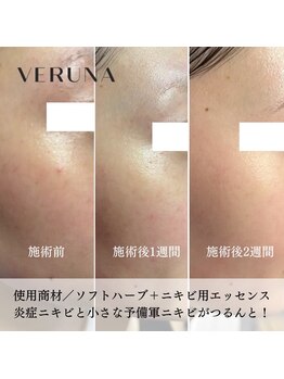 ココ 2号店(CoCo)/ハーブピーリング/ソフトハーブ