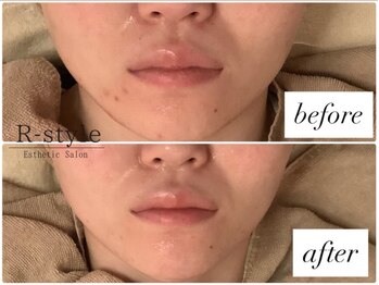 エステサロン アールスタイル(R-style)/プラズマシャワー+ハーブ