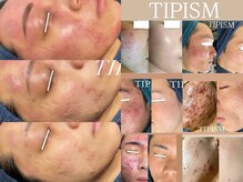 アリス(ALICE)/TIPハーブピーリング