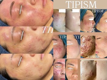 アリス(ALICE)/TIPハーブピーリング