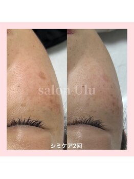 ウル(Ulu)/シミケア、光フェイシャル