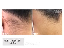 ビープランニング(B-PLANNING.)/【うなじ×襟足 、無料！】