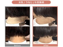 アンフィー 川西能勢口店(Une f`ee)/うなじ脱毛のBefore,After★