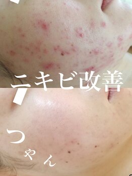 ピウ(piu)/【ニキビ】ハーバルピーリング