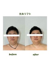アトリエドゥアージュ(Atelier de age)/男性もたるみケア[紹介のみ]