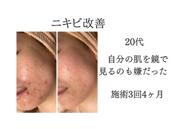 シャルナ(charna)/ニキビ改善