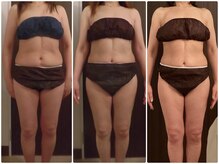 痩身脱毛専門店 グレイスボディ MEGAドンキホーテ三郷店(Gracebody)/◆痩身　症例写真