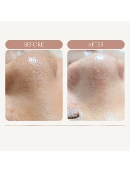 エミナル バイ ニコドット(Eminal by nico.)/産毛と角栓詰まり2回目のケア後