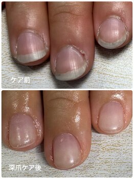 モストネイル 五日市店(MOST nail)/深爪ケアで美しい爪へ