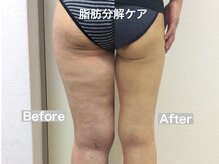 マッチ(much)/脂肪分解ケア　2カ月8回