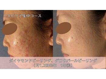 オーシャンブルー 時津店(OCEAN BLUE)/ニキビケア集中コース