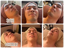 32℃ パストラル(Pastorale)の雰囲気（men'sヒゲ脱毛。１回30分　お試し3800円痛み軽減、効果絶大。）