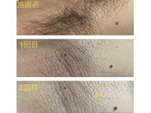 ヨロ 梅郷店(YOLO)/★わき脱毛★