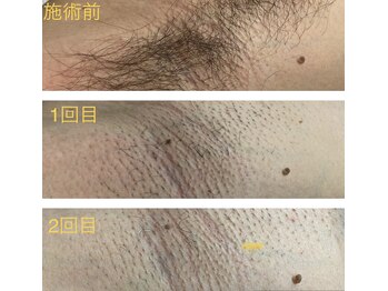 ヨロ 梅郷店(YOLO)/★わき脱毛★