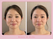 ボーテドリッシュ(Beaute de Riche)/小顔矯正でググッとリフトＵＰ
