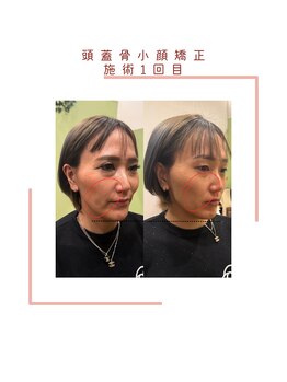 ヴィヴァーチェ(VIVACE)/頭蓋骨小顔矯正ビフォーアフター