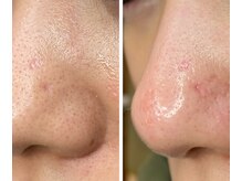 サイ(Sai)/before⇒after