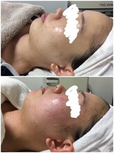 ビズビズ 天王寺店(bisebise)/ニキビ/毛穴開き黒ずみ角栓詰り