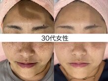 シミケア専門店 SAKURA 平塚店/平塚シミケア/伊勢店シミケア