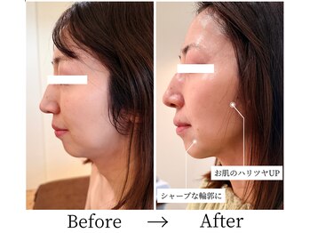 ビーズスタイル(B’S STYLE)の写真/気になるお顔の脂肪を分解&切らずに叶うリフトアップ!脂肪分解レッドショットで理想の小顔へ♪