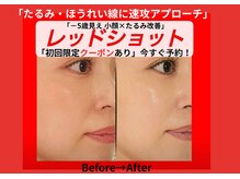 アン 銀座(ann)の雰囲気（レッドショットで内側からハリUP!ツヤと美白でテンションUP!!）