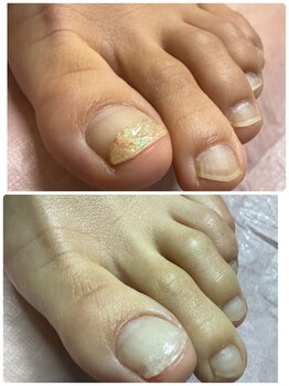 【フットケア】巻き爪・肥厚爪