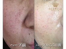 ラ ヴィレ ボーテ(La vraie beaute’)/before after