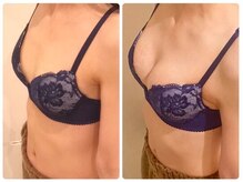 デミーナ(Demyna)/【バストアップ】症例 育乳