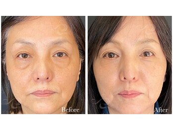 カノン(Kanon.)/リベルハーブピーリング