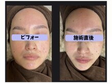 アイリー(IRIE)/インモード　ワンセラ