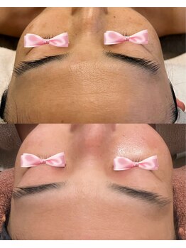 美温(mion)/10ヶ月の肌変化