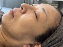 ラルミエール 緑店はなれ(la lumiere)/肌質改善！リゼネレート