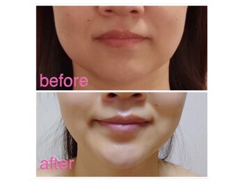 痩身脱毛専門店 グレイスボディ MEGAドンキホーテ三郷店(Gracebody)/リフトアップマシン利用　2