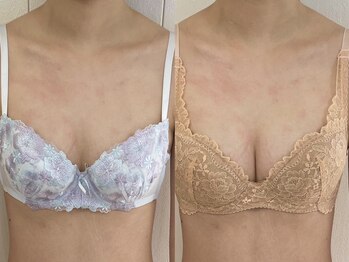 美人バスト 横浜店/バストアップ症例/育乳(6回施術)