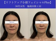 リプロ(RePro)/30代　ビフォーアフター