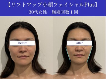 リプロ(RePro)/30代 ビフォーアフター