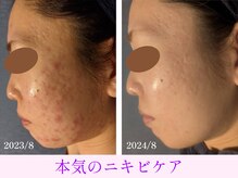 オーシャンブルー 日田店/本気のニキビケア