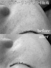 ビエン(bien)/施術12回.陶肌ハーブピーリング